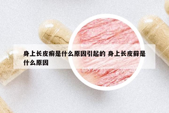 身上長(zhǎng)皮癬是什么原因引起的 身上長(zhǎng)皮蘚是什么原因