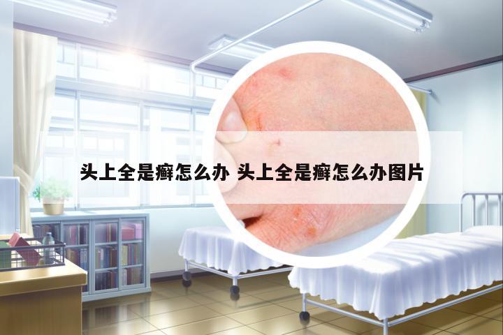 頭上全是癬怎么辦 頭上全是癬怎么辦圖片