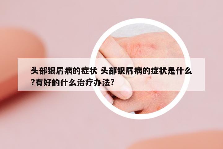 頭部銀屑病的癥狀 頭部銀屑病的癥狀是什么?有好的什么治療辦法?