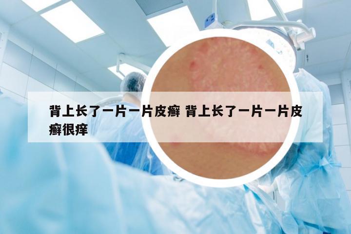 背上長了一片一片皮癬 背上長了一片一片皮癬很癢