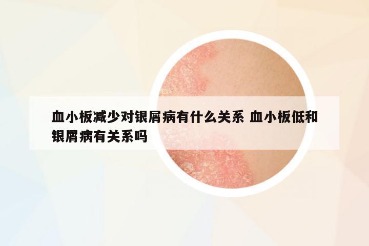 血小板減少對銀屑病有什么關系 血小板低和銀屑病有關系嗎