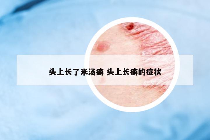 頭上長了米湯癬 頭上長癬的癥狀
