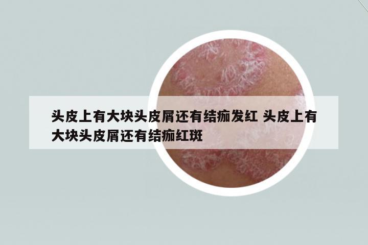 頭皮上有大塊頭皮屑還有結(jié)痂發(fā)紅 頭皮上有大塊頭皮屑還有結(jié)痂紅斑