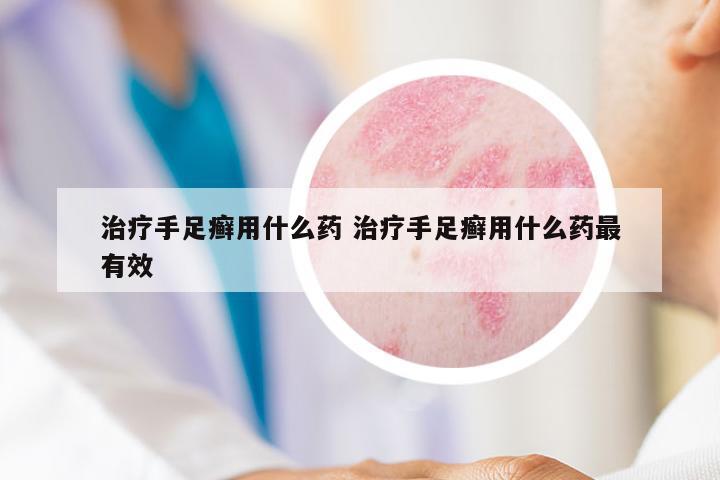 治療手足癬用什么藥 治療手足癬用什么藥最有效