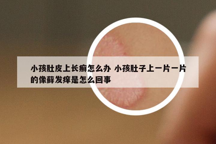 小孩肚皮上長癬怎么辦 小孩肚子上一片一片的像蘚發(fā)癢是怎么回事