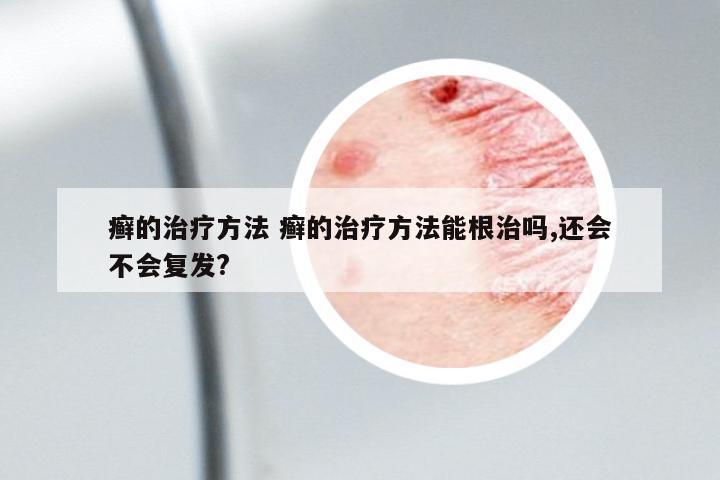 癬的治療方法 癬的治療方法能根治嗎,還會不會復(fù)發(fā)?