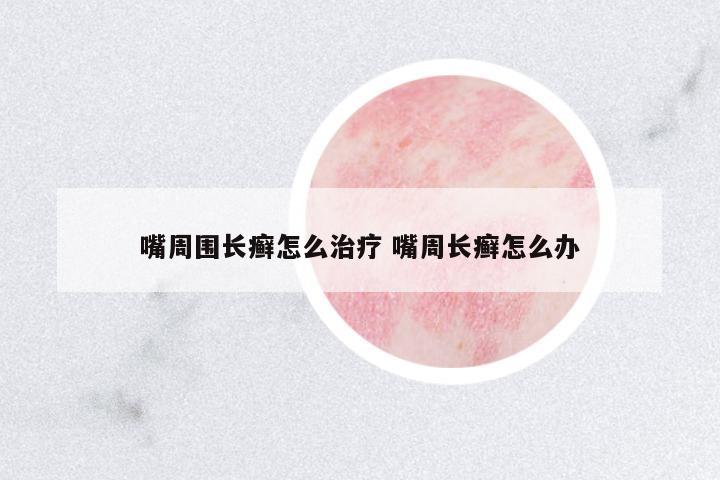 嘴周圍長癬怎么治療 嘴周長癬怎么辦