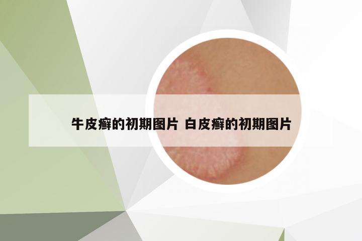 牛皮癬的初期圖片 白皮癬的初期圖片