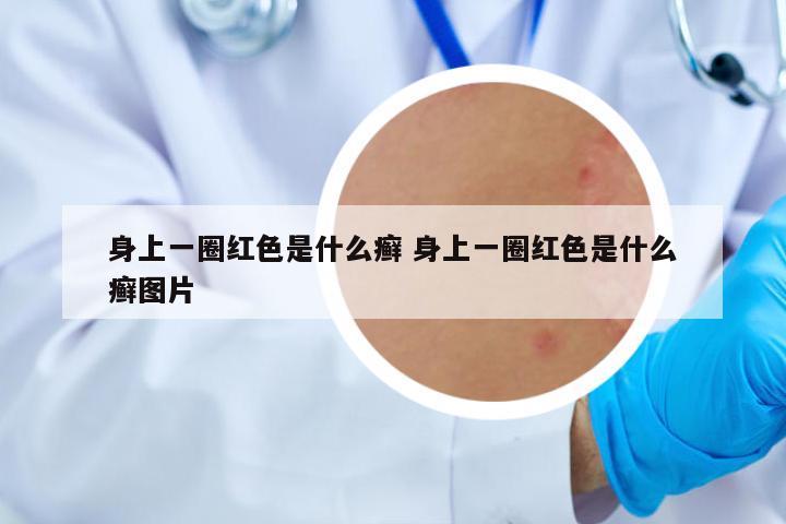 身上一圈紅色是什么癬 身上一圈紅色是什么癬圖片