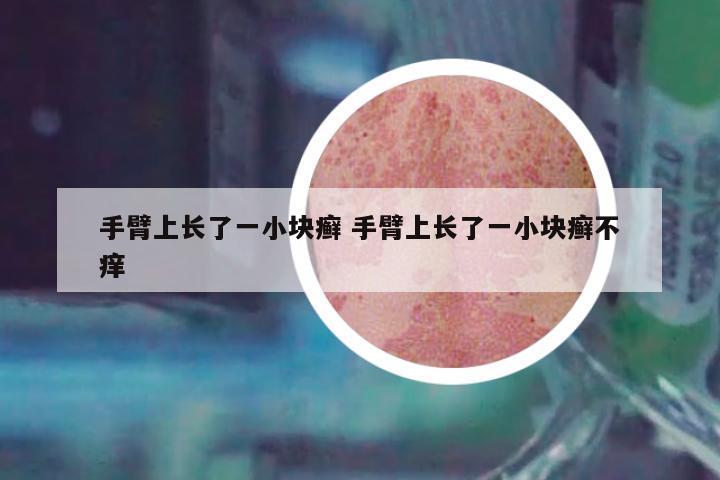 手臂上長(zhǎng)了一小塊癬 手臂上長(zhǎng)了一小塊癬不癢
