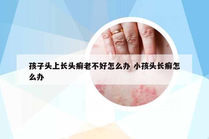 孩子頭上長頭癬老不好怎么辦 小孩頭長癬怎么辦