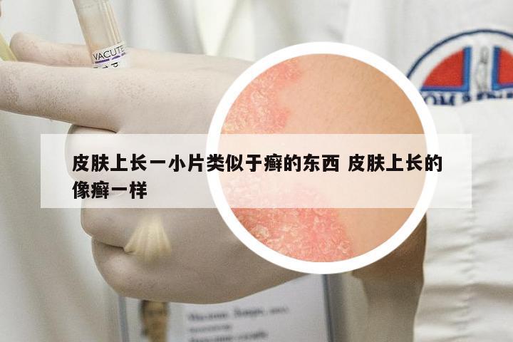 皮膚上長一小片類似于癬的東西 皮膚上長的像癬一樣