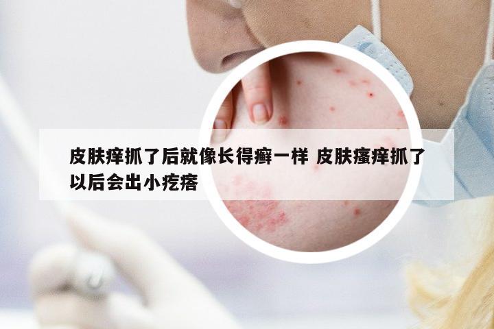 皮膚癢抓了后就像長得癬一樣 皮膚瘙癢抓了以后會(huì)出小疙瘩