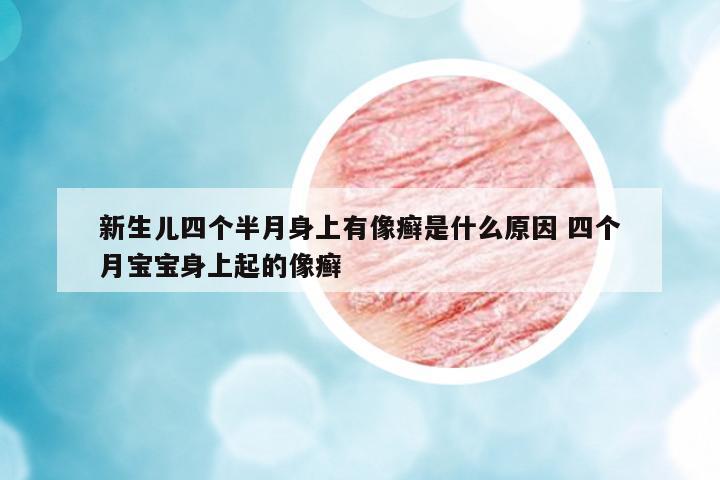 新生兒四個半月身上有像癬是什么原因 四個月寶寶身上起的像癬