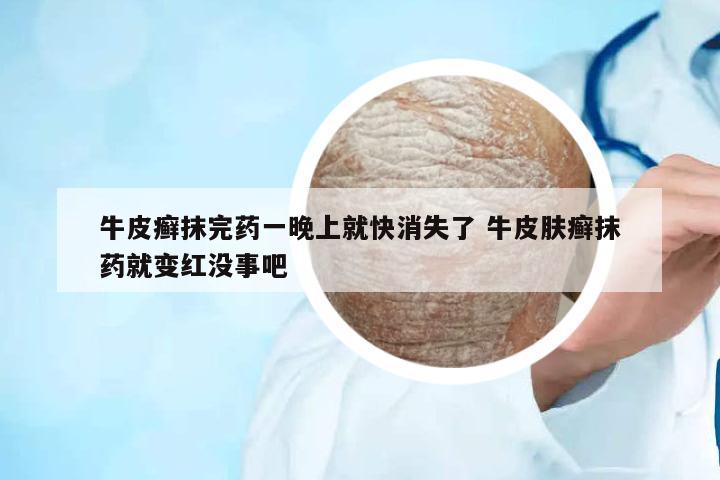 牛皮癬抹完藥一晚上就快消失了 牛皮膚癬抹藥就變紅沒事吧
