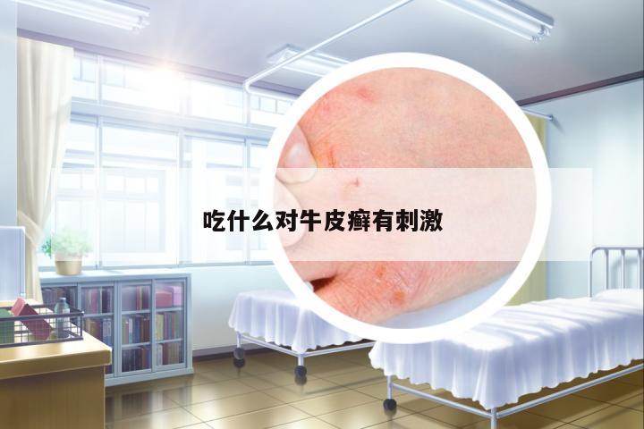 吃什么對(duì)牛皮癬有刺激