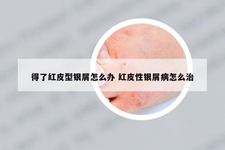 得了紅皮型銀屑怎么辦 紅皮性銀屑病怎么治