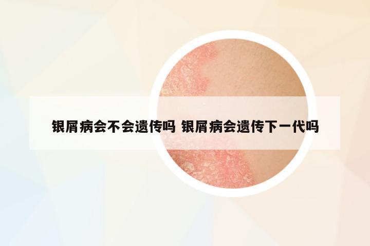 銀屑病會不會遺傳嗎 銀屑病會遺傳下一代嗎
