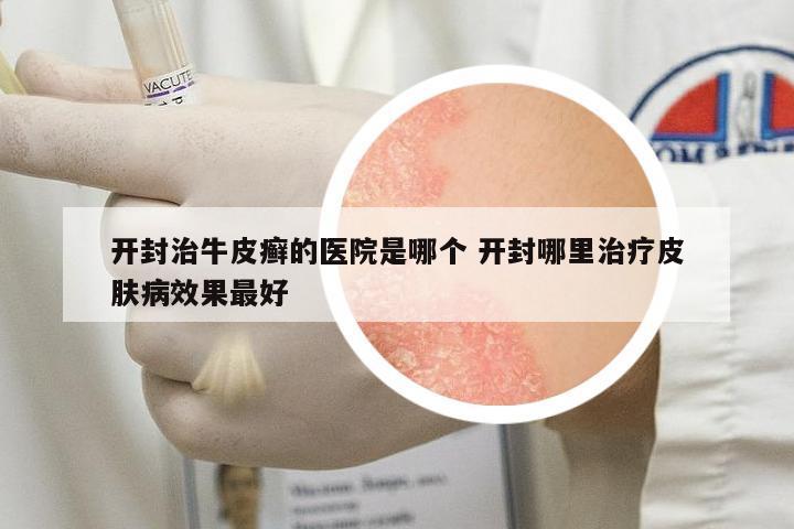 開封治牛皮癬的醫(yī)院是哪個(gè) 開封哪里治療皮膚病效果最好