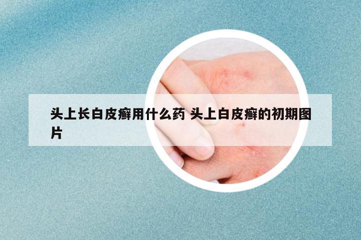 頭上長白皮癬用什么藥 頭上白皮癬的初期圖片