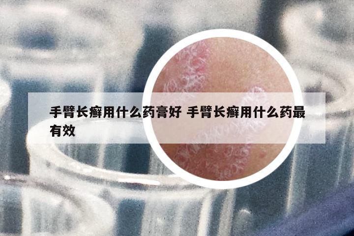 手臂長癬用什么藥膏好 手臂長癬用什么藥最有效