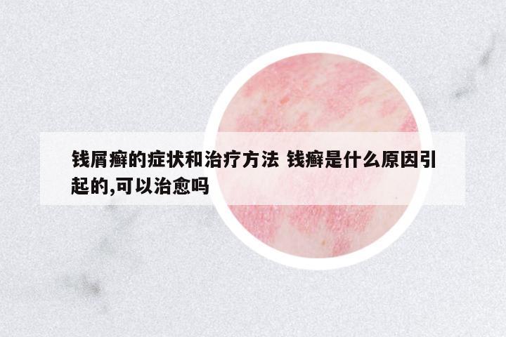 錢屑癬的癥狀和治療方法 錢癬是什么原因引起的,可以治愈嗎