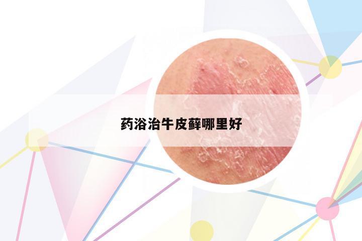 藥浴治牛皮蘚哪里好