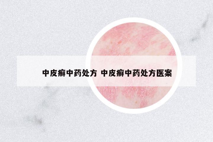 中皮癬中藥處方 中皮癬中藥處方醫(yī)案