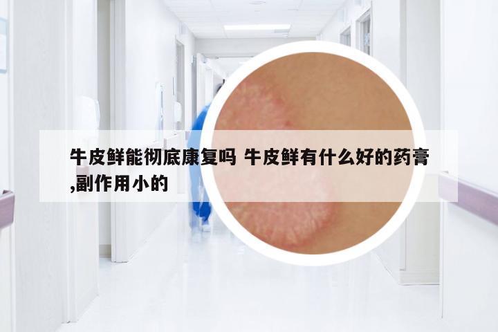 牛皮鮮能徹底康復(fù)嗎 牛皮鮮有什么好的藥膏,副作用小的