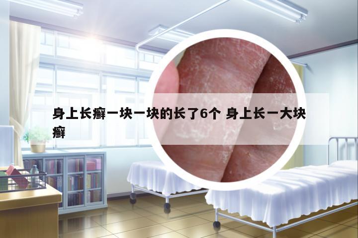 身上長癬一塊一塊的長了6個 身上長一大塊癬