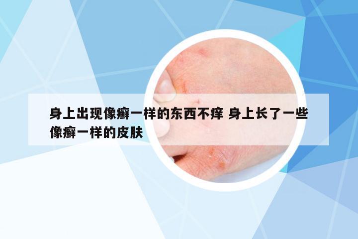 身上出現(xiàn)像癬一樣的東西不癢 身上長了一些像癬一樣的皮膚