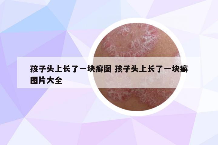 孩子頭上長了一塊癬圖 孩子頭上長了一塊癬圖片大全
