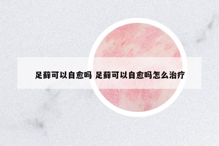 足蘚可以自愈嗎 足蘚可以自愈嗎怎么治療