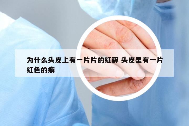 為什么頭皮上有一片片的紅蘚 頭皮里有一片紅色的癬
