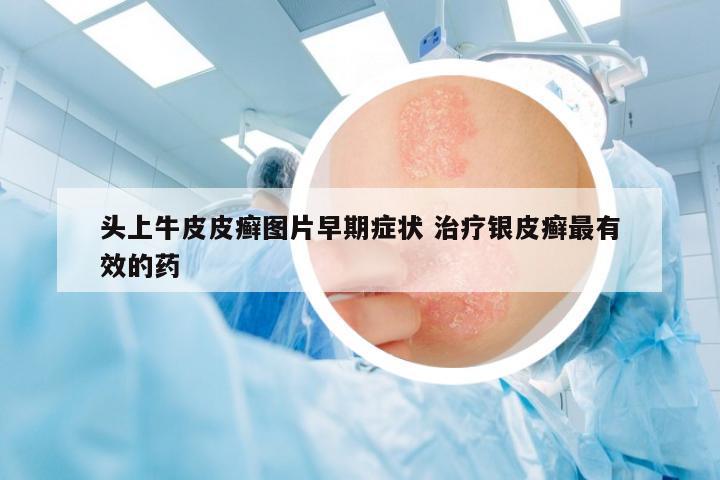 頭上牛皮皮癬圖片早期癥狀 治療銀皮癬最有效的藥
