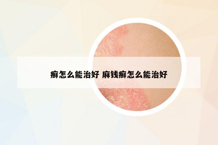 癬怎么能治好 麻錢癬怎么能治好