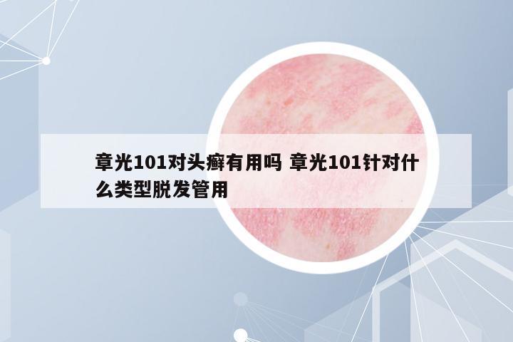 章光101對頭癬有用嗎 章光101針對什么類型脫發(fā)管用