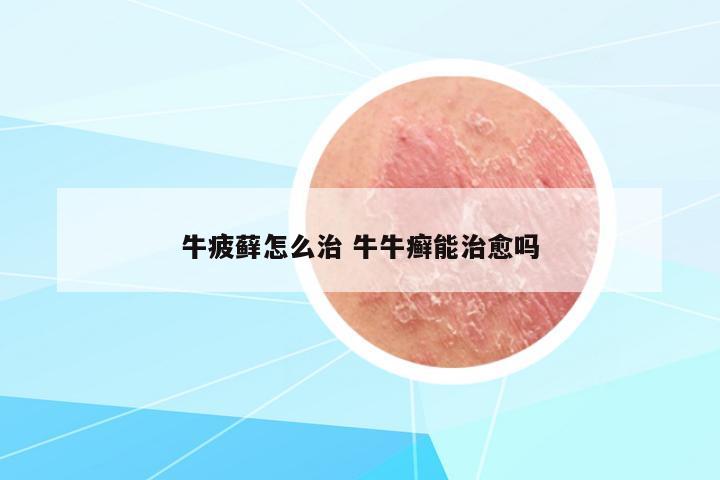 牛疲蘚怎么治 牛牛癬能治愈嗎