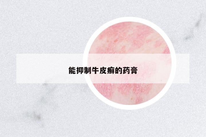 能抑制牛皮癬的藥膏