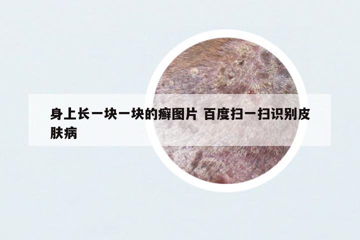 身上長(zhǎng)一塊一塊的癬圖片 百度掃一掃識(shí)別皮膚病