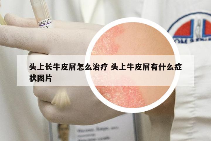 頭上長(zhǎng)牛皮屑怎么治療 頭上牛皮屑有什么癥狀圖片