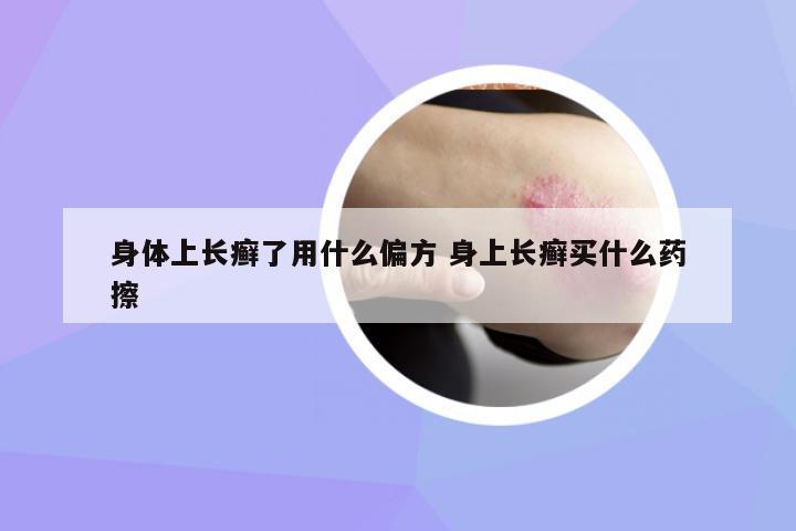 身體上長癬了用什么偏方 身上長癬買什么藥擦