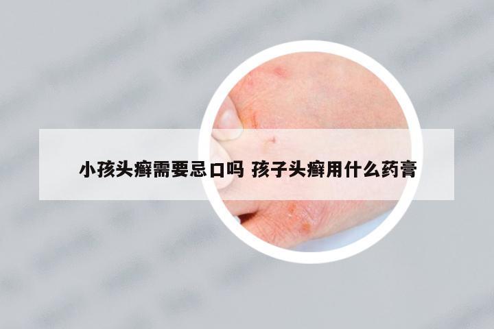 小孩頭癬需要忌口嗎 孩子頭癬用什么藥膏