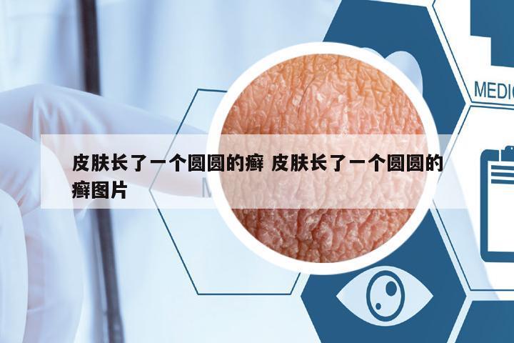 皮膚長了一個(gè)圓圓的癬 皮膚長了一個(gè)圓圓的癬圖片