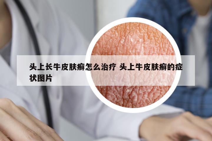 頭上長牛皮膚癬怎么治療 頭上牛皮膚癬的癥狀圖片