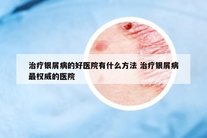 治療銀屑病的好醫(yī)院有什么方法 治療銀屑病最權(quán)威的醫(yī)院