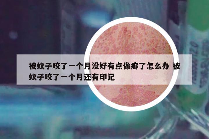 被蚊子咬了一個月沒好有點(diǎn)像癬了怎么辦 被蚊子咬了一個月還有印記