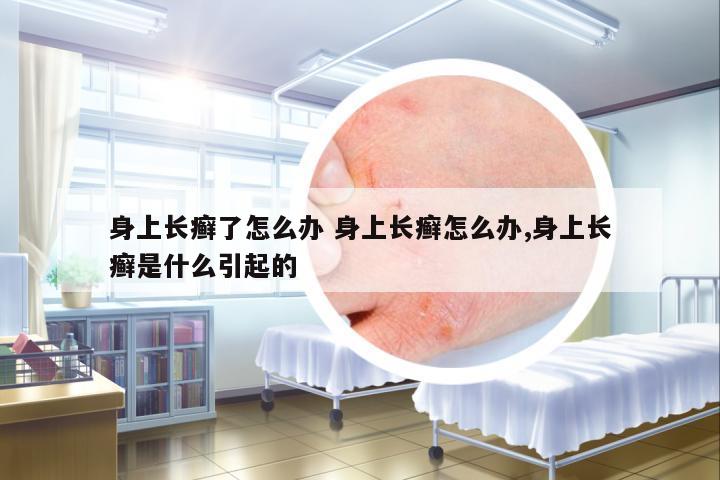 身上長癬了怎么辦 身上長癬怎么辦,身上長癬是什么引起的