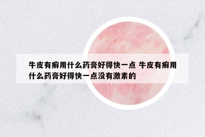 牛皮有癬用什么藥膏好得快一點 牛皮有癬用什么藥膏好得快一點沒有激素的