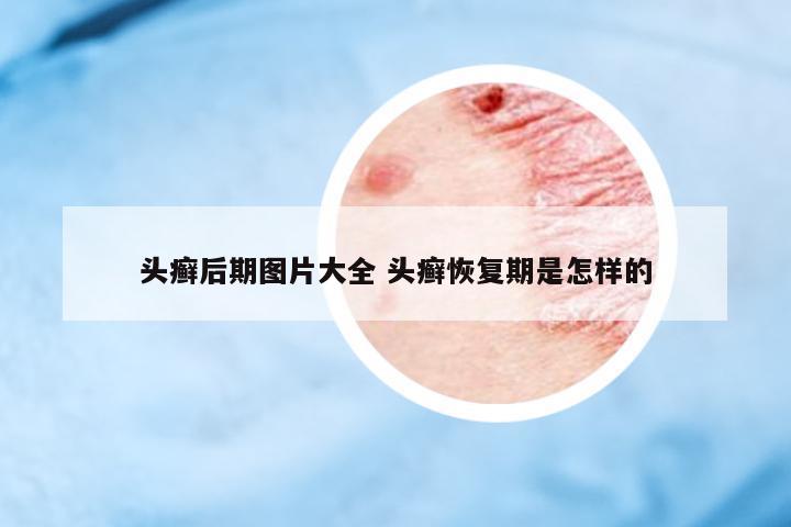 頭癬后期圖片大全 頭癬恢復期是怎樣的
